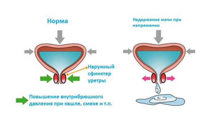 При гипотонии (слабости) возможно развитие парадоксальной ишурии. У таких женщин на фоне переполнения органа может выделяться моча по каплям