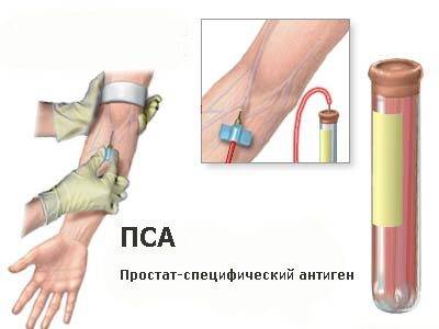 Какая норма пса после удаления рака простаты?