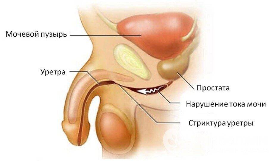 Признаки уретрита у мужчин