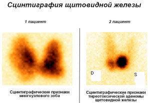 Сцинтиграфия: подготовка, как проводится, где сделать, показания и виды