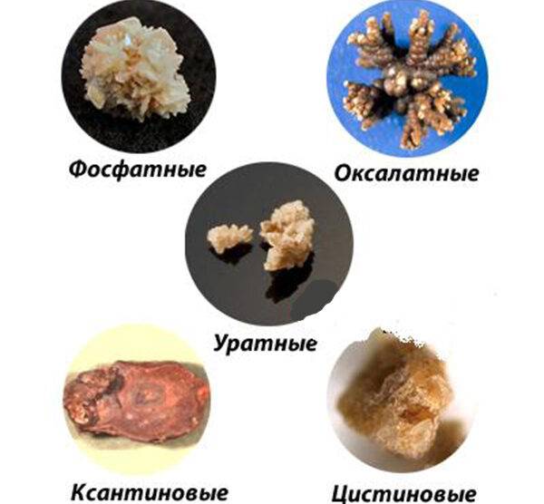 Виды камней в почках: фото, описание и методы диагностики