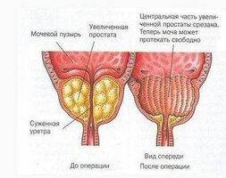 Как часто делать массаж простаты: рекомендации врачей-урологов