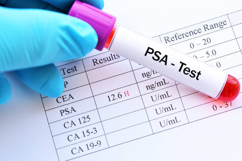ПСА общий: показания, расшифровка, подготовка к анализу