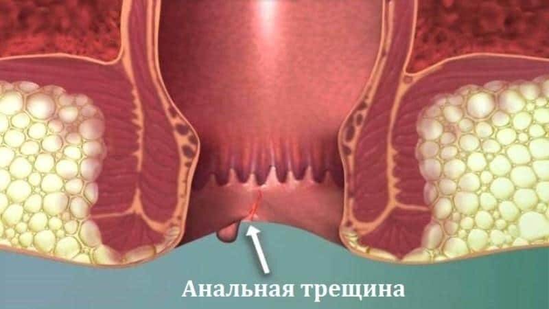 Чувство распирания в прямой кишке причины