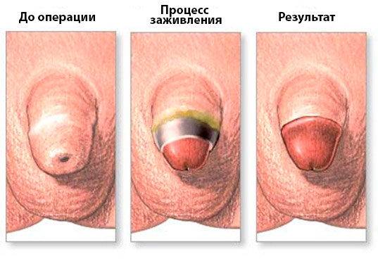 Циркумизия, вид до и после операции
