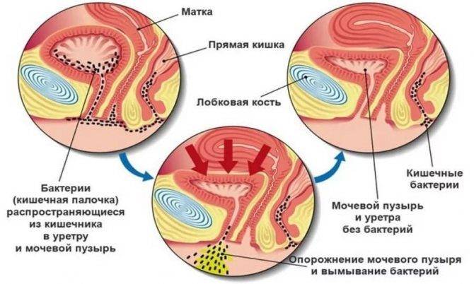 Причины задержки месячных из-за цистита у женщин, как лечить цистит во время месячных антибиотиками в домашних условиях