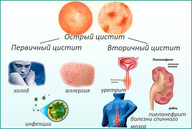 Острый и хронический виды цистита