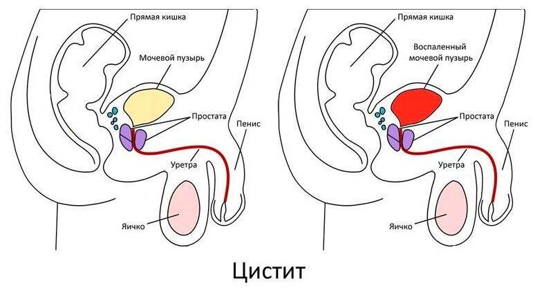 Симптомы и лечение цистита у мужчин