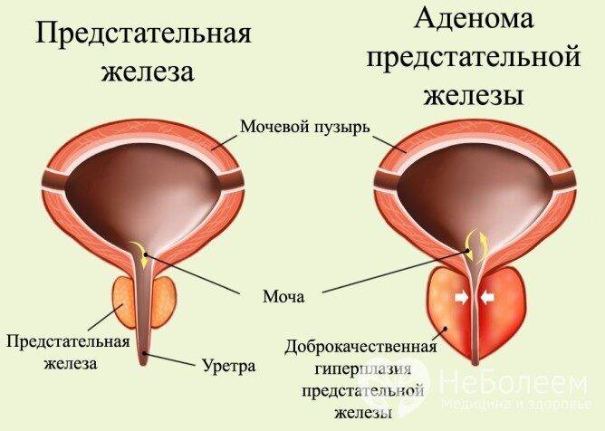 Гиперплазия предстательной железы: симптомы и лечение