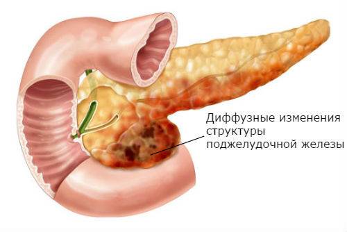 Эхоструктура паренхимы диффузно неоднородная