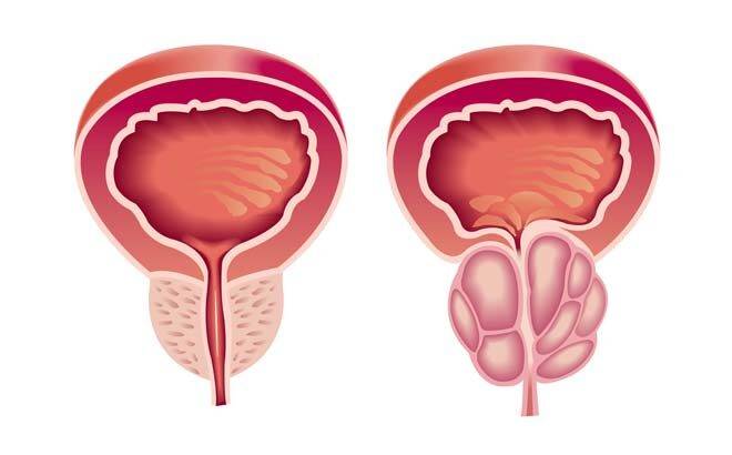 От чего бывает аденома простаты у мужчин