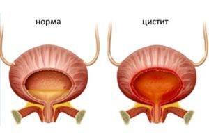 Болит мочевой пузырь - причины у мужчины и женщины, симптомы, чем лечить
