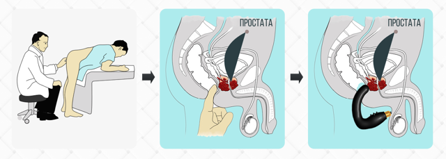 Профессиональный массаж простаты: техника выполнения процедуры
