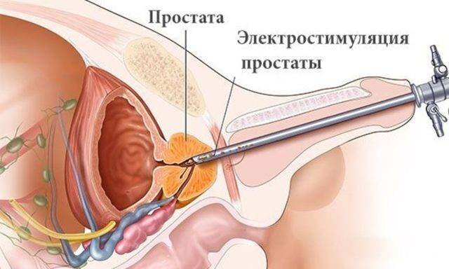 Стимуляция простаты: техника процедуры и противопоказания к ней