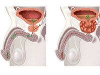Доброкачественная гиперплазия предстательной железы