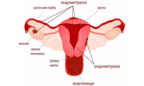 Дизурические расстройства могут вызвать не только воспалительные, но и другие заболевания, например, эндометриоз