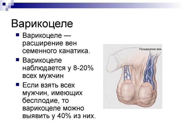 Варикоцеле: причины, признаки, постановка диагноза и методы лечения болезни у мужчин