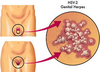 Герпес на половом члене
