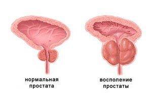 Болит мочевой пузырь - причины у мужчины и женщины, симптомы, чем лечить