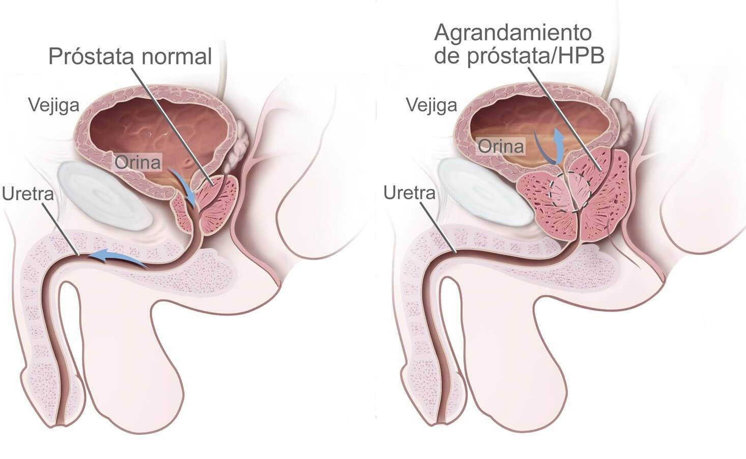 Ts Prostate