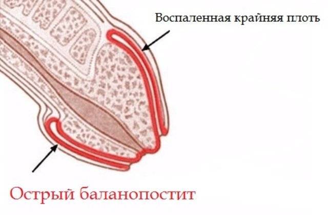 Баланопостит при сахарном диабете лечение