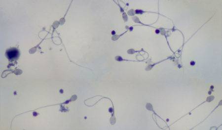 Агглютинация сперматозоидов: причины и лечение обнаруженной агглютинации