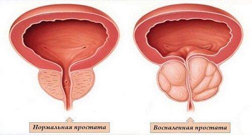 Фиброз простаты