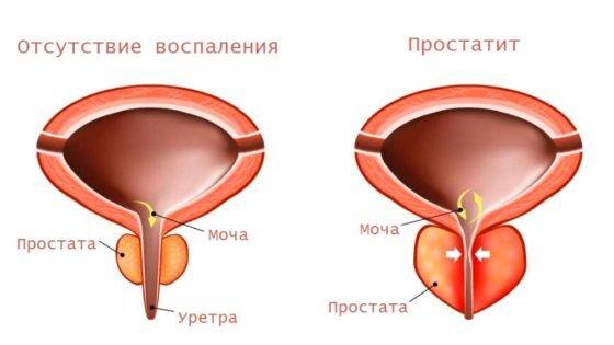 простатит