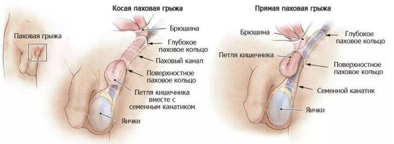 рисунок паховой грыжи