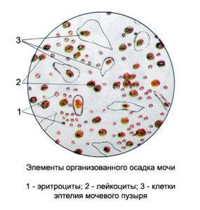 Клетки плоского эпителия в моче