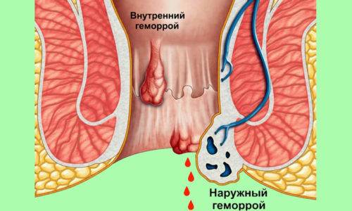 Умирают ли от геморроя