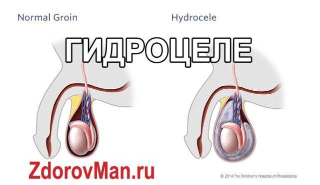 Причины водянки яичка у взрослого мужчины