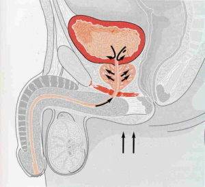 После мочеиспускания дискомфорт у мужчин — Prostatittut