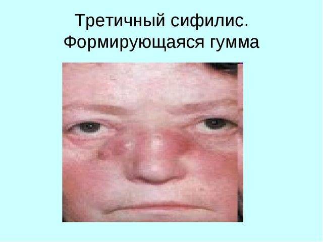 третичный