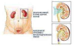 камень в устье мочеточника как удалить