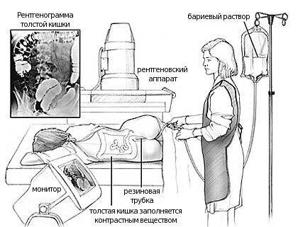 Ирригоскопия