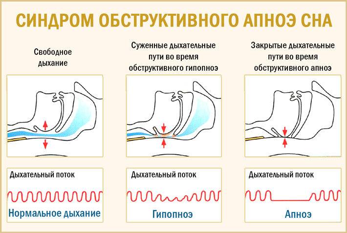 Синдром обструктивного апноэ сна