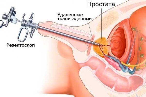 Удалили простату как восстановить потенцию