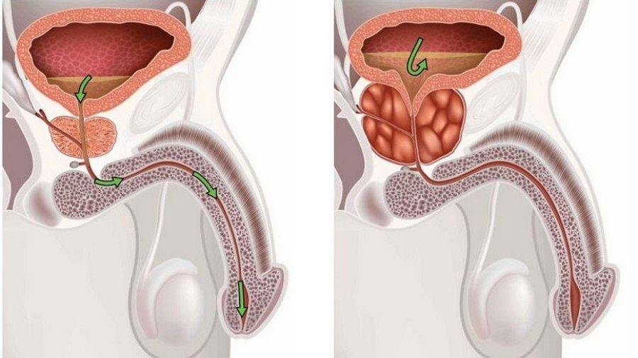 От чего бывает аденома простаты у мужчин