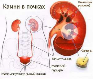 Камни в почках