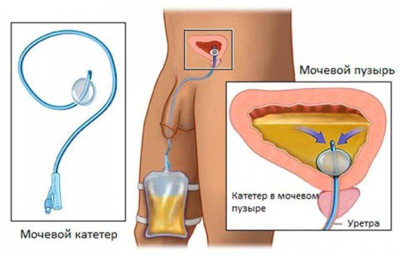 уретральный катетер