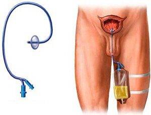 Катетеризация мочевого пузыря