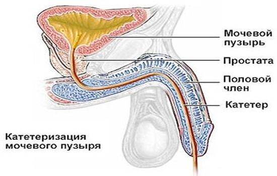 Катетеризация мочевого пузыря у женщин, мужчин: алгоритм и техника введения