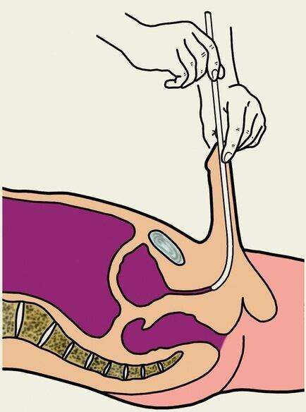 Катетеризация мочевого пузыря. Алгоритм выполнения, техника, осложнения