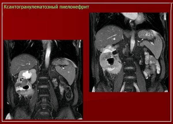 КТ-признаки ксантогранулематозного пиелонефрита
