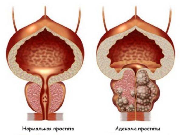 massazh-prostaty-pri-adenome-prostaty-600x445-1