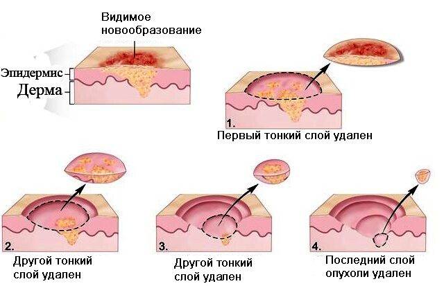 Новообразования на коже лица, руки, шеи, ягодиц, стопы ноги, головы. Виды, причины, удаление лазером