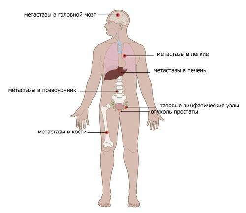 Метастазы в костях и органах при раке предстательной железы