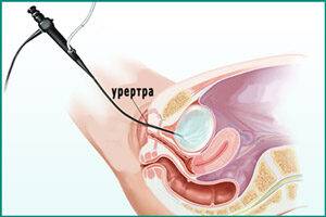 Проведение цистоскопии