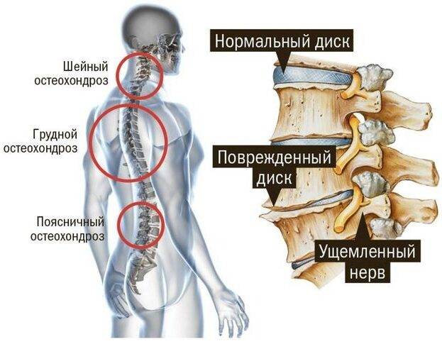 Мовалис (Movalis) уколы. Отзывы пациентов, инструкция, аналоги, цена